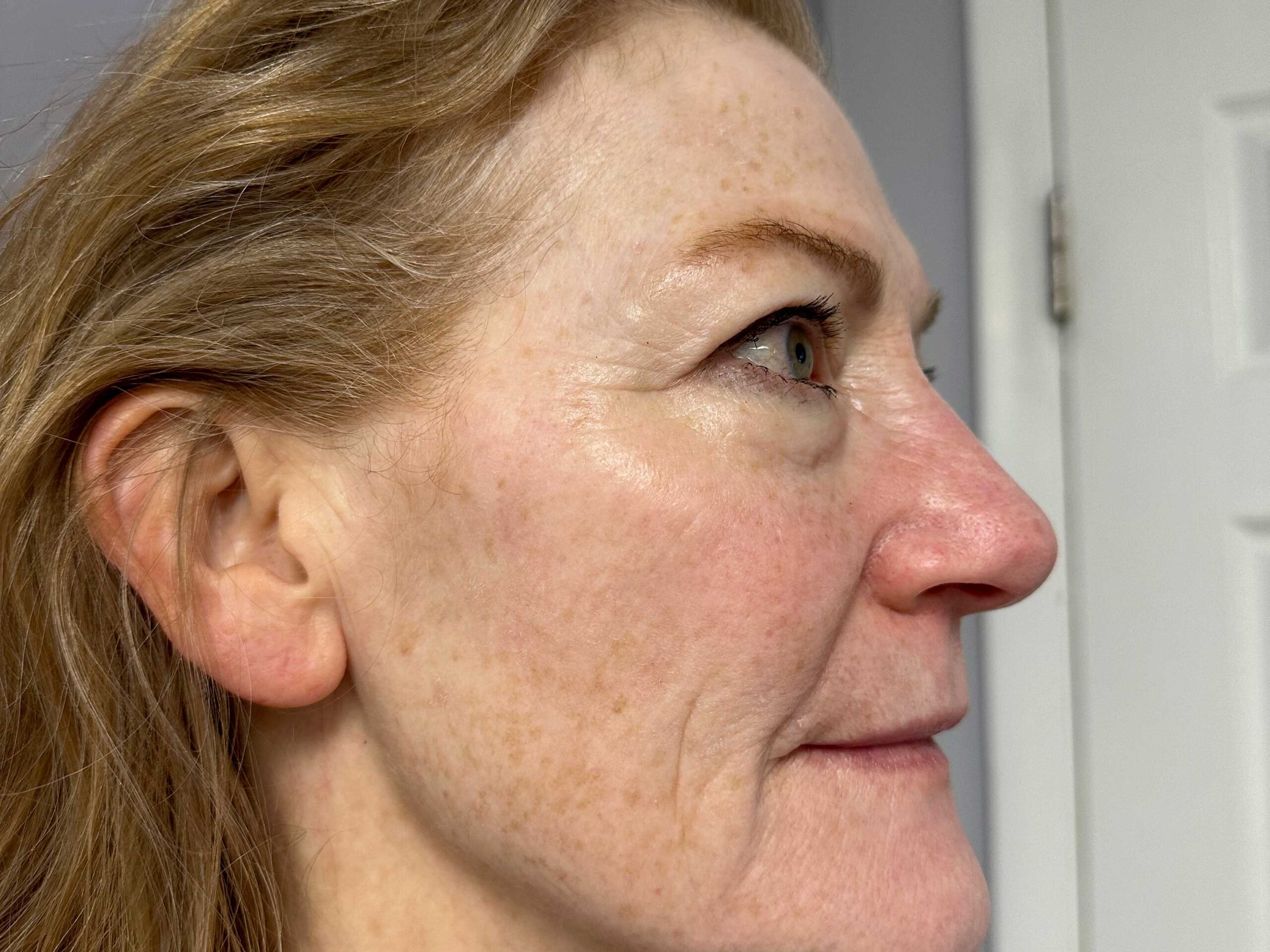 After three targeted microcurrent treatments